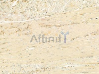 RSAD2 Antibody - DF12227 at 1/100 staining human tongue carcinoma by IHC-P.