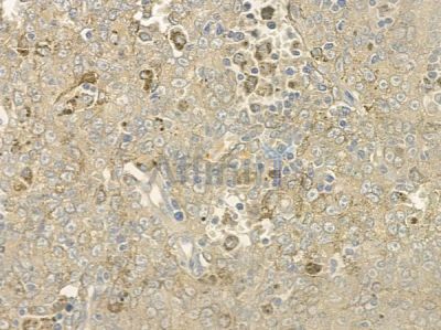 SPTLC2 Antibody - DF12231 at 1/100 staining human melanoma by IHC-P.