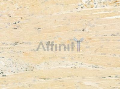 BBS7 Antibody - DF12249 at 1/100 staining human tongue carcinoma by IHC-P.