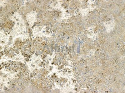 CCDC22 Antibody - DF12251 at 1/100 staining human melanoma by IHC-P.