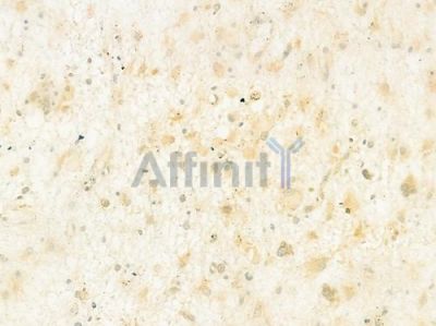 CHCHD3 Antibody - DF12254 at 1/100 staining human astrocytoma by IHC-P.