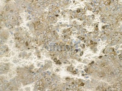 CHCHD6 Antibody - DF12255 at 1/100 staining human melanoma by IHC-P.