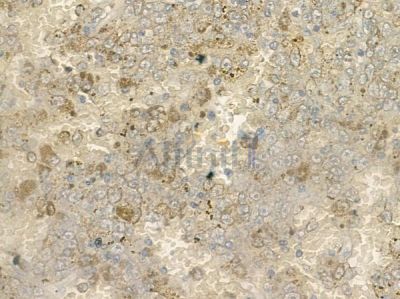 CMIP Antibody - DF12258 at 1/100 staining human melanoma by IHC-P.