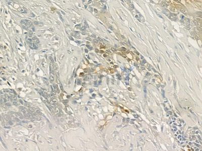 CREST Antibody - DF12262 at 1/100 staining human breast carcinoma by IHC-P.