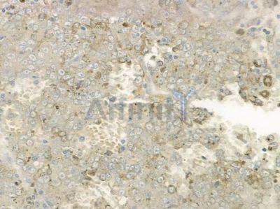 HPS5 Antibody - DF12281 at 1/100 staining human melanoma by IHC-P.