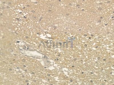 KIF12 Antibody - DF12285 at 1/100 staining human glioblastoma by IHC-P.