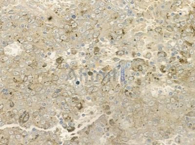 PMPCB Antibody - DF12305 at 1/100 staining human melanoma by IHC-P.