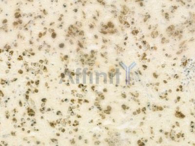PRPF8 Antibody - DF12306 at 1/100 staining human melanoma by IHC-P.