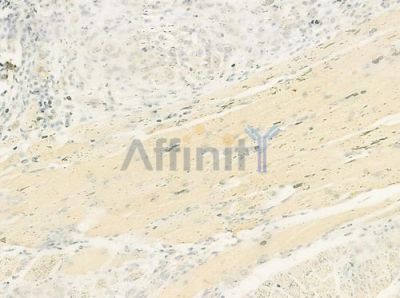 Secretogranin III Antibody - DF12316 at 1/100 staining human tongue carcinoma by IHC-P.