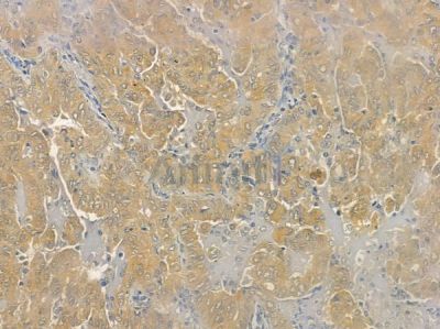 SRP14 Antibody - DF12323 at 1/100 staining human lung adenocarcinoma by IHC-P.
