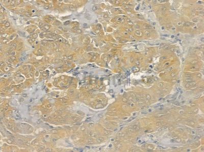 SRP14 Antibody - DF12323 at 1/100 staining human lung adenocarcinoma by IHC-P.