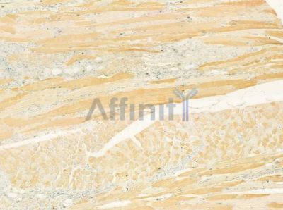 TIMM17B Antibody - DF12331 at 1/100 staining human tongue carcinoma by IHC-P.