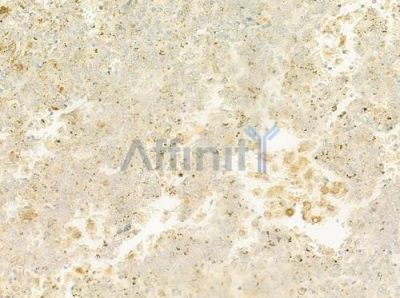 ZnT3 Antibody - DF12344 at 1/100 staining human melanoma by IHC-P.