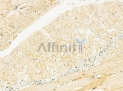 alpha Adaptin Antibody - DF12347 at 1/100 staining human tongue carcinoma by IHC-P.