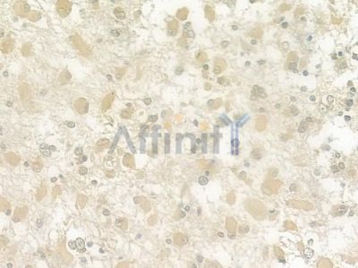 Antizyme inhibitor 1 Antibody - DF12348 at 1/100 staining human astrocytoma by IHC-P.