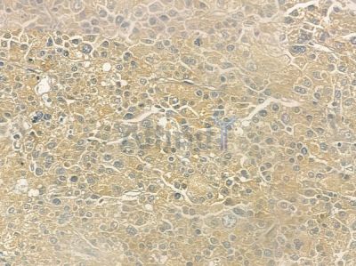 ATP6V1A Antibody - DF12353 at 1/100 staining human hepatocellular carcinoma by IHC-P.