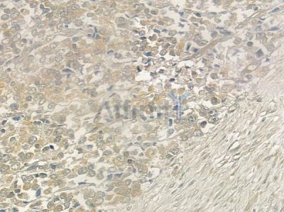 BBS10 Antibody - DF12356 at 1/100 staining human prostate carcinoma by IHC-P.