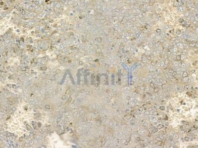 BBS3 Antibody - DF12357 at 1/100 staining human melanoma by IHC-P.