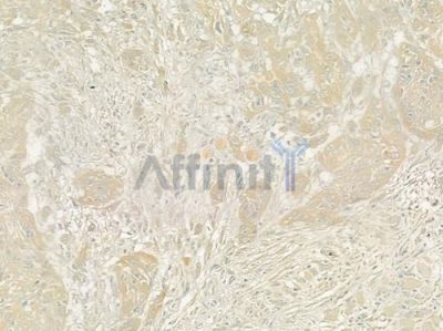 CALCOCO2 Antibody - DF12360 at 1/100 staining human tongue carcinoma by IHC-P.
