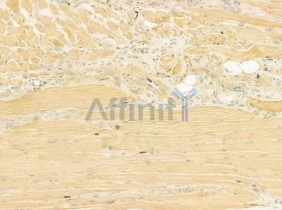 CHCHD4 Antibody - DF12364 at 1/100 staining human tongue carcinoma by IHC-P.