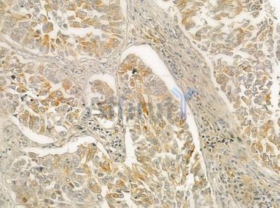CTNNA3 Antibody - DF12375 at 1/100 staining human lung squamous cell carcinoma by IHC-P.