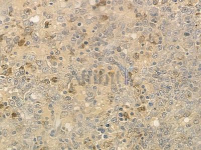 DIS3 Antibody - DF12383 at 1/100 staining human melanoma by IHC-P.