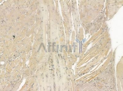 DNAJC19 Antibody - DF12384 at 1/100 staining human tongue carcinoma by IHC-P.
