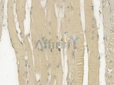 EIF3I Antibody - DF12393 at 1/100 staining human tongue carcinoma by IHC-P.
