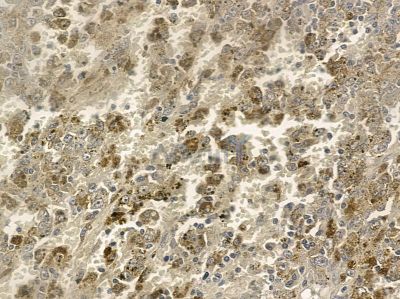 EXOC5 Antibody - DF12397 at 1/100 staining human liver cancer by IHC-P.