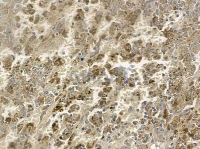 EXOC5 Antibody - DF12397 at 1/100 staining human melanoma by IHC-P.