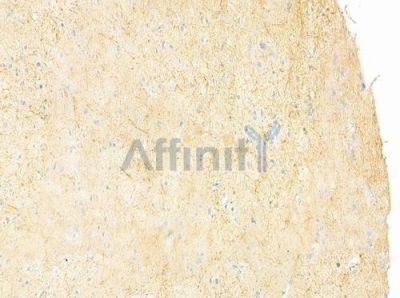 FAM65B Antibody - DF12398 at 1/100 staining human glioblastoma by IHC-P.