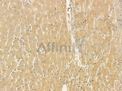 GEFT Antibody - DF12403 at 1/100 staining human hepatocellular carcinoma by IHC-P.