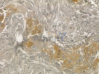 GMFG Antibody - DF12405 at 1/100 staining human lung adenocarcinoma by IHC-P.