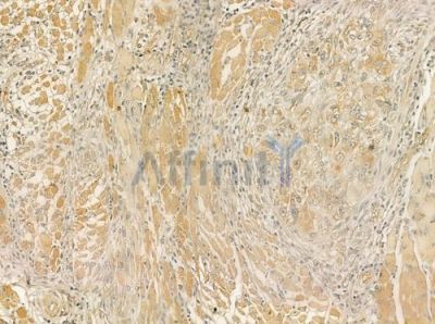 HBS1L Antibody - DF12410 at 1/100 staining human tongue carcinoma by IHC-P.