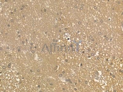 KCTD12 Antibody - DF12414 at 1/100 staining human glioblastoma by IHC-P.
