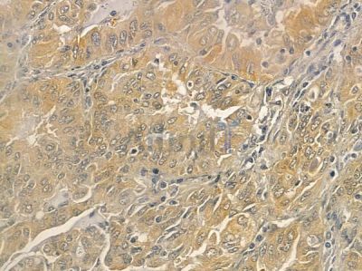 KIDINS220 Antibody - DF12415 at 1/100 staining human lung adenocarcinoma by IHC-P.