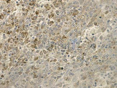 MMP28 Antibody - DF12423 at 1/100 staining human melanoma by IHC-P.
