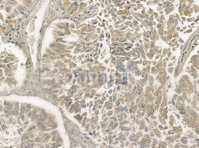 MMP28 Antibody - DF12423 at 1/100 staining human lung squamous cell carcinoma by IHC-P.