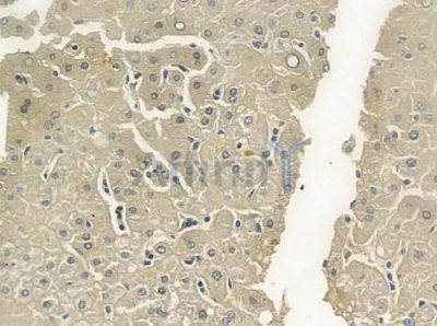 MTHFD1L Antibody - DF12425 at 1/100 staining human hepatocellular carcinoma by IHC-P.