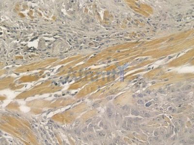 MYH6 Antibody - DF12426 at 1/100 staining human tongue carcinoma by IHC-P.