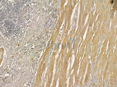 OXA1L Antibody - DF12437 at 1/100 staining human colon carcinoma by IHC-P.