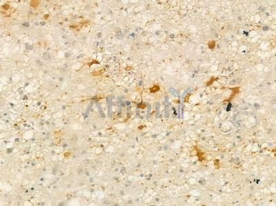 P3H3 Antibody - DF12439 at 1/100 staining human astrocytoma by IHC-P.
