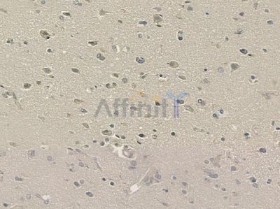 PHF11 Antibody - DF12450 at 1/100 staining human glioblastoma by IHC-P.