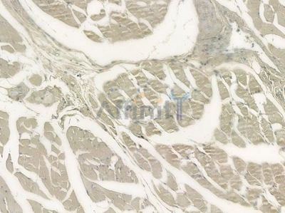 RAB12 Antibody - DF12459 at 1/100 staining human lung adenocarcinoma by IHC-P.
