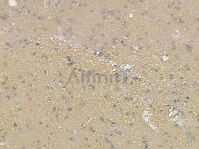 RAB14 Antibody - DF12460 at 1/100 staining human glioblastoma by IHC-P.