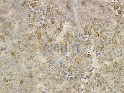 REEP2 Antibody - DF12463 at 1/100 staining human melanoma by IHC-P.