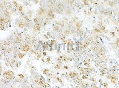 RIC8B Antibody - DF12465 at 1/100 staining human melanoma by IHC-P.