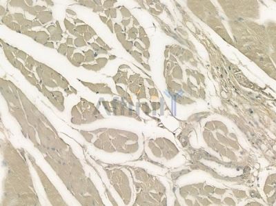 RLBP1 Antibody - DF12466 at 1/100 staining human tongue carcinoma by IHC-P.