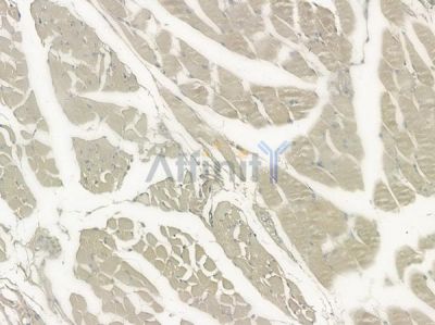 ROGDI Antibody - DF12467 at 1/100 staining human tongue carcinoma by IHC-P.