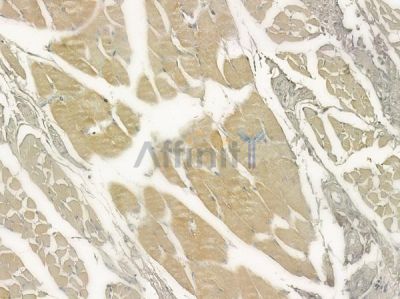 SEC63 Antibody - DF12471 at 1/100 staining human tongue carcinoma by IHC-P.